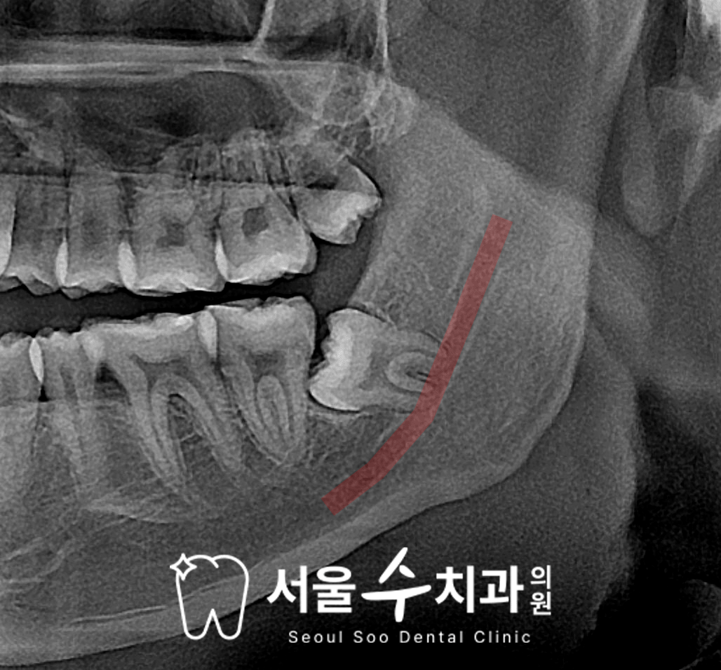 율량동치과 사랑니 정밀 진단 예시