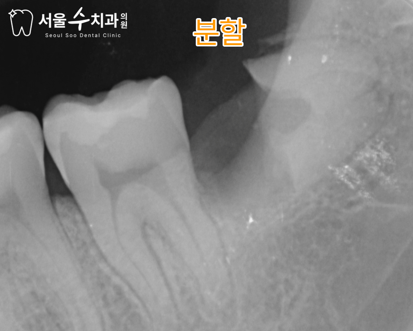 율량동치과 사랑니 정밀 진단 예시