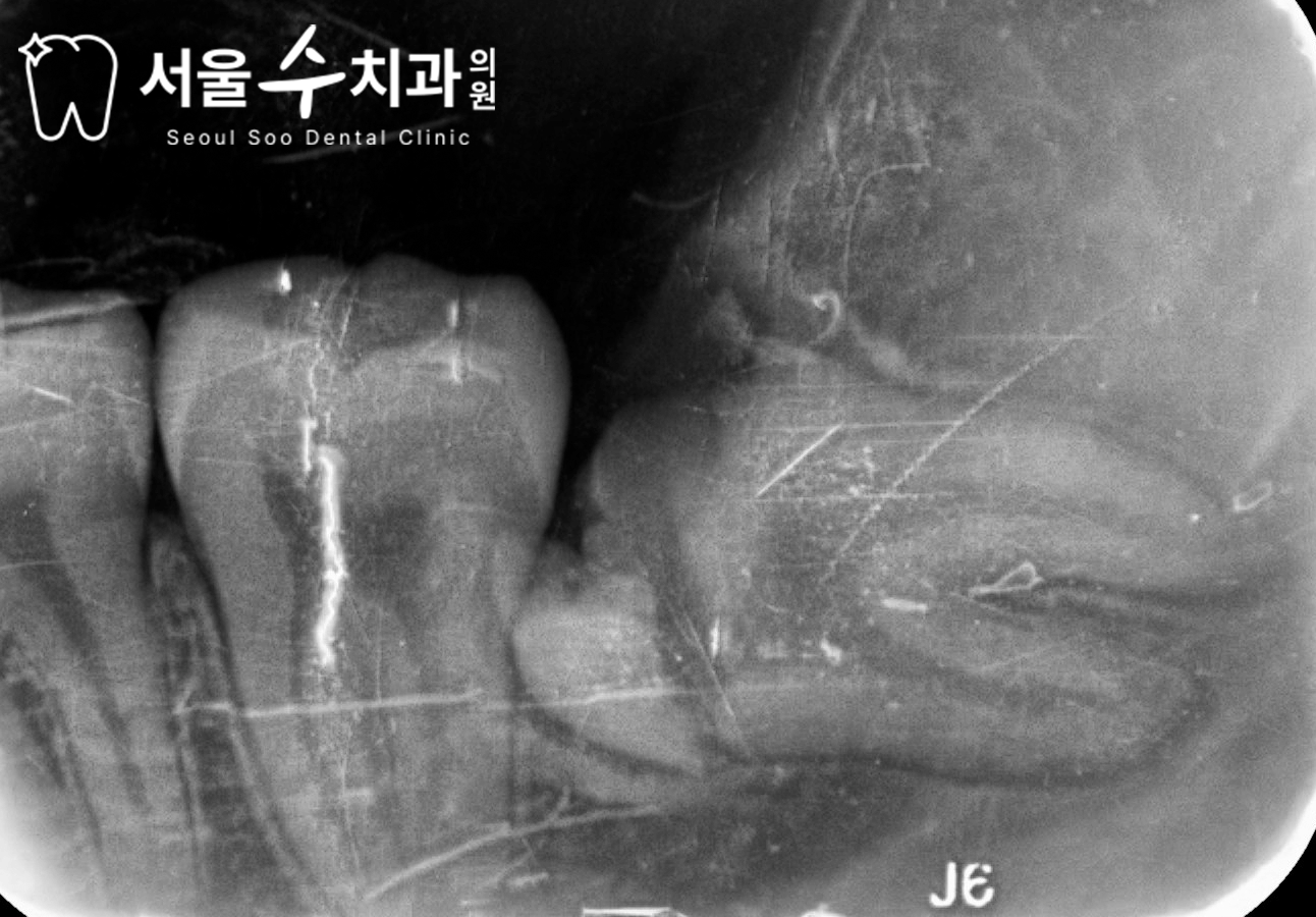 완전 매복 사랑니 발치