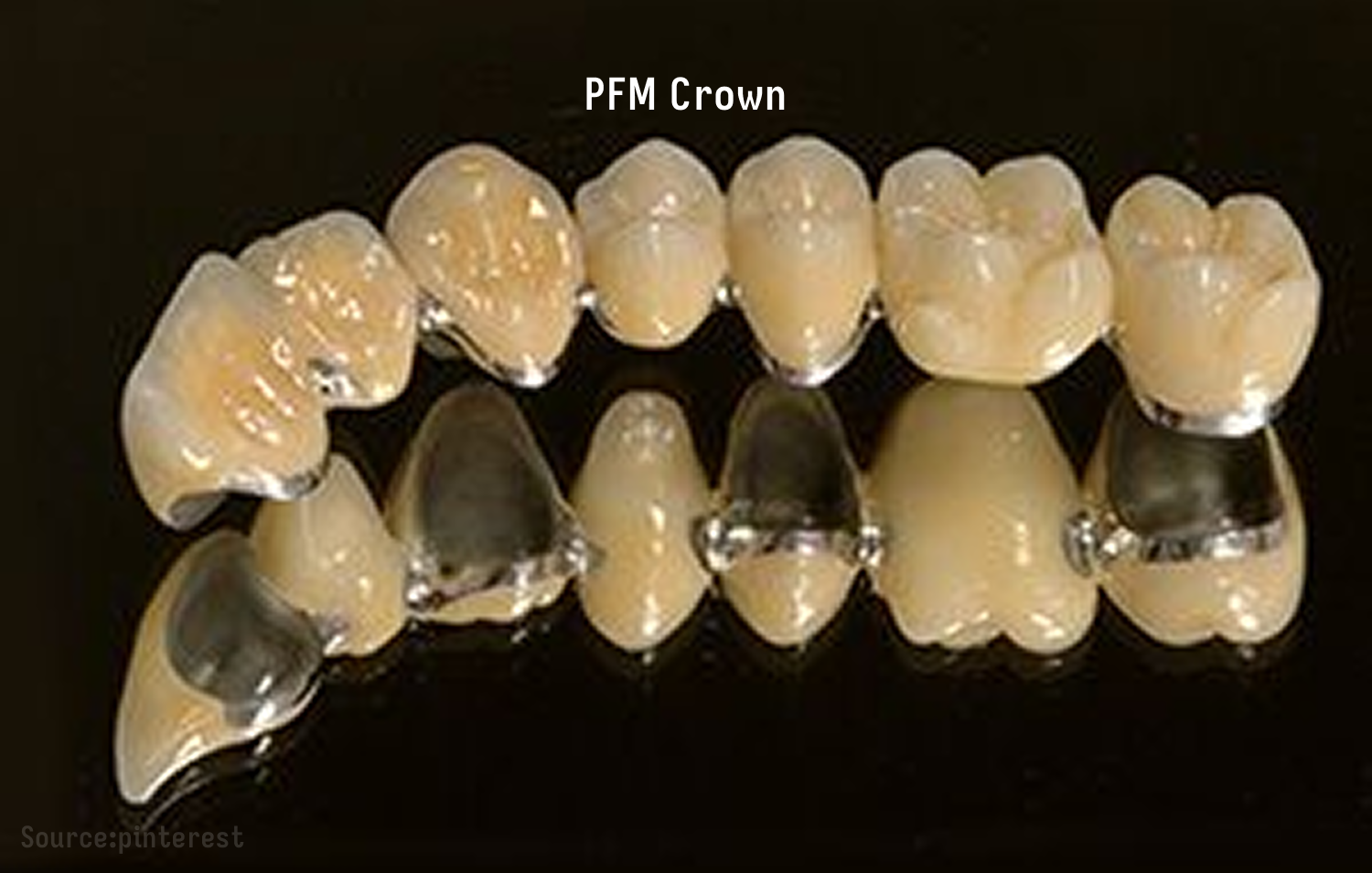 청원구 율중로 PFM 크라운 보철