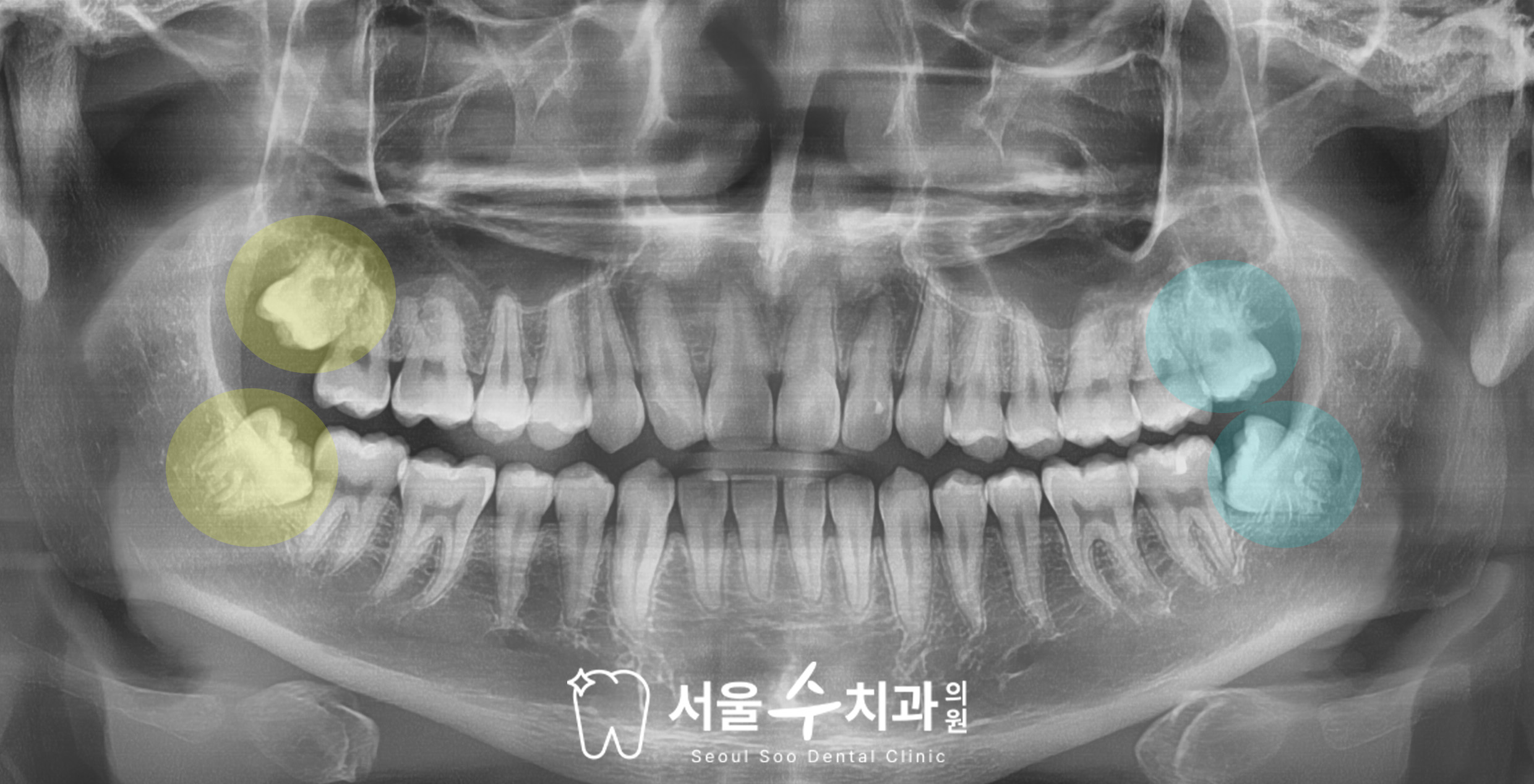 단순 사랑니 발치