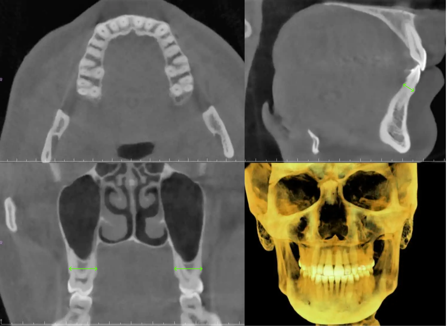 청주치과, CBCT 골조직 3D 분석