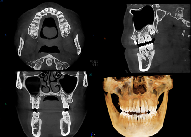 서울수치과 임플란트 CBCT 진단