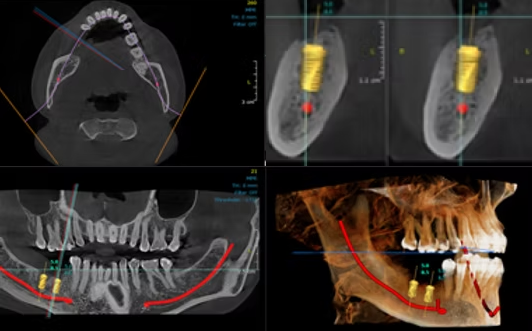 CBCT 임플란트 시뮬레이션 화면