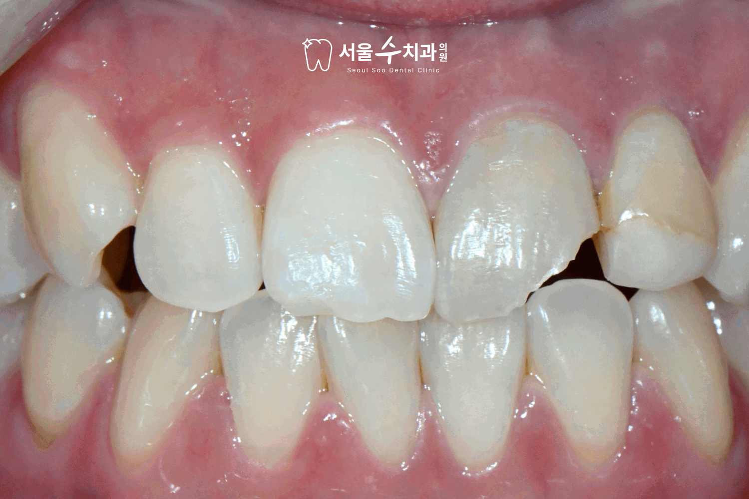 앞니치아파절 응급진료 서울수치과