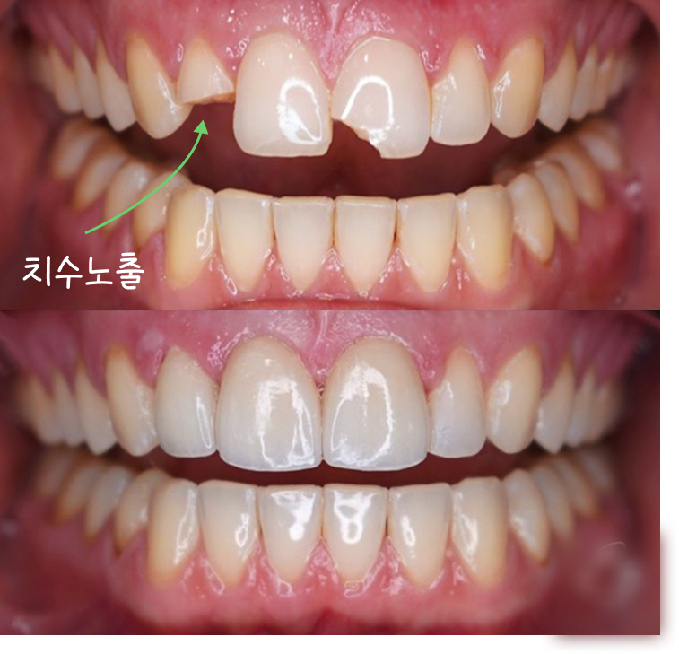 앞니치아파절 원인 설명 이미지