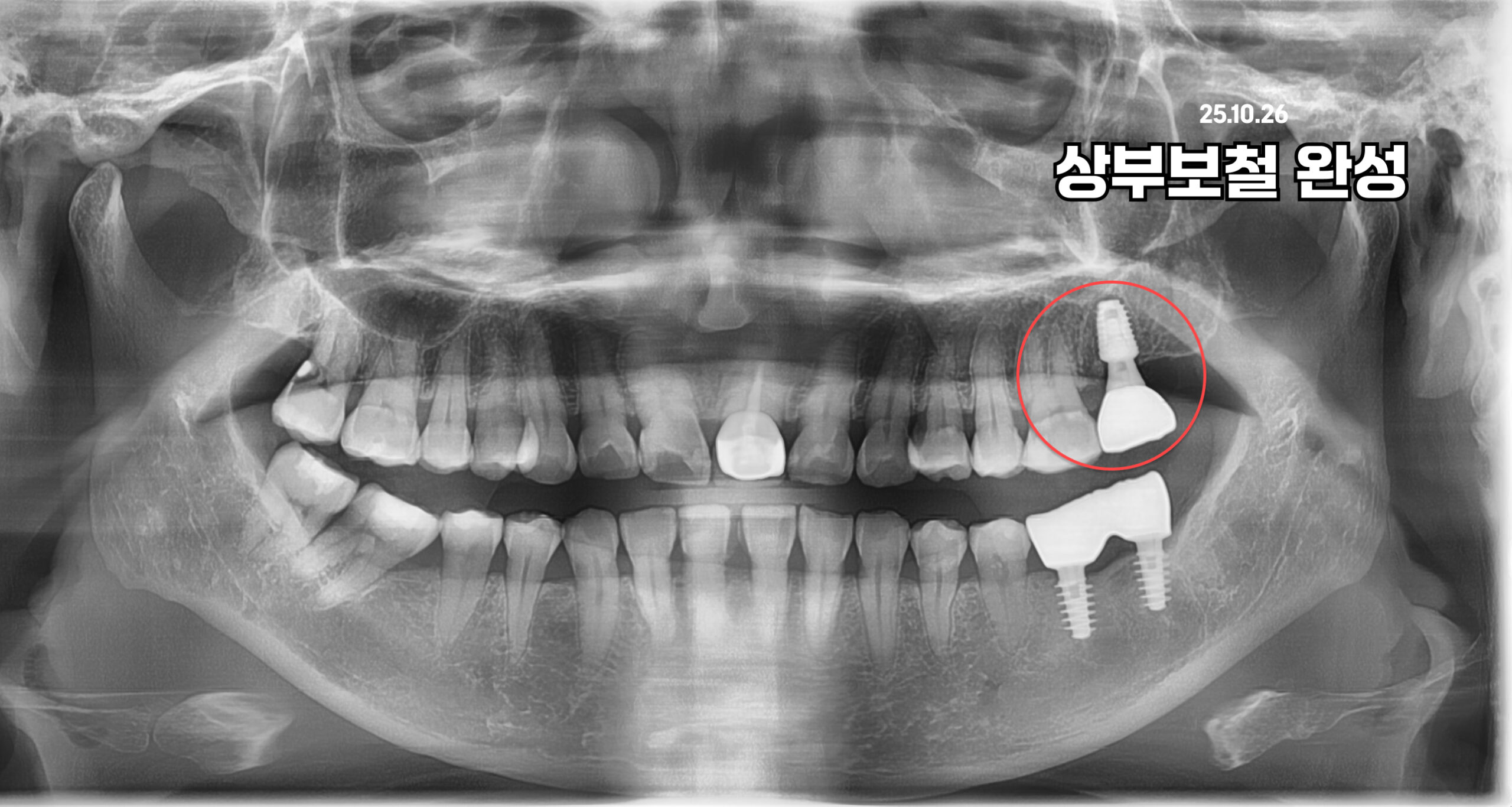 청주치과 건강보험 임플란트 지르코니아 안내 상부보철 완료 서울수치과
