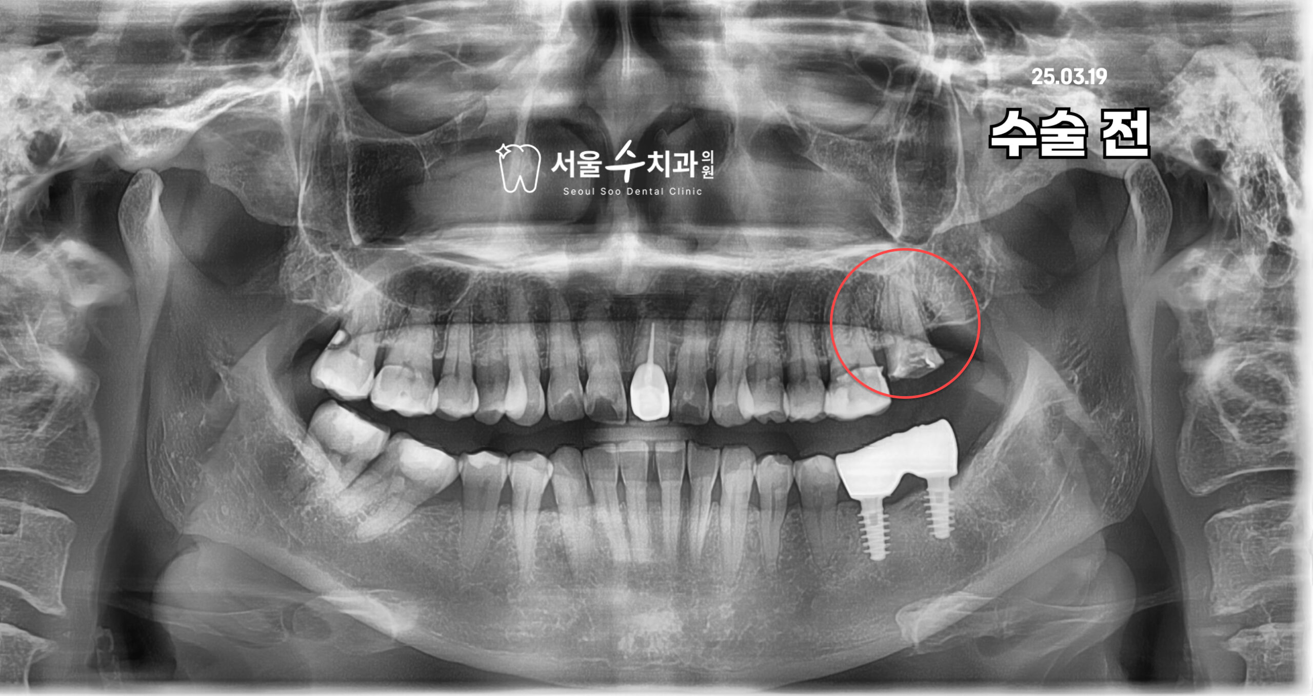 청주치과 건강보험 임플란트 수술 전 서울수치과