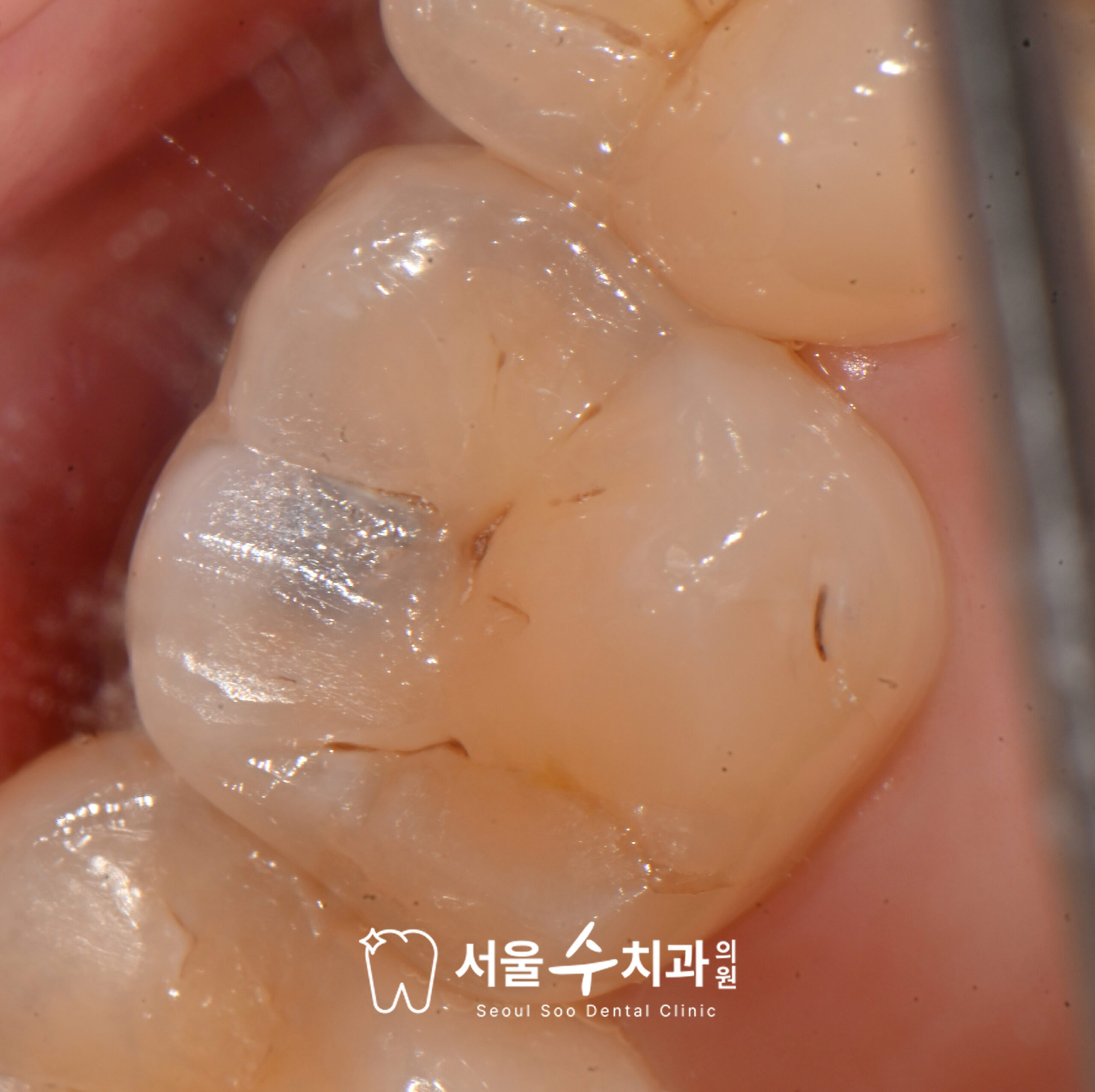 영구치 충치 상태 — 청원구치과 서울수치과