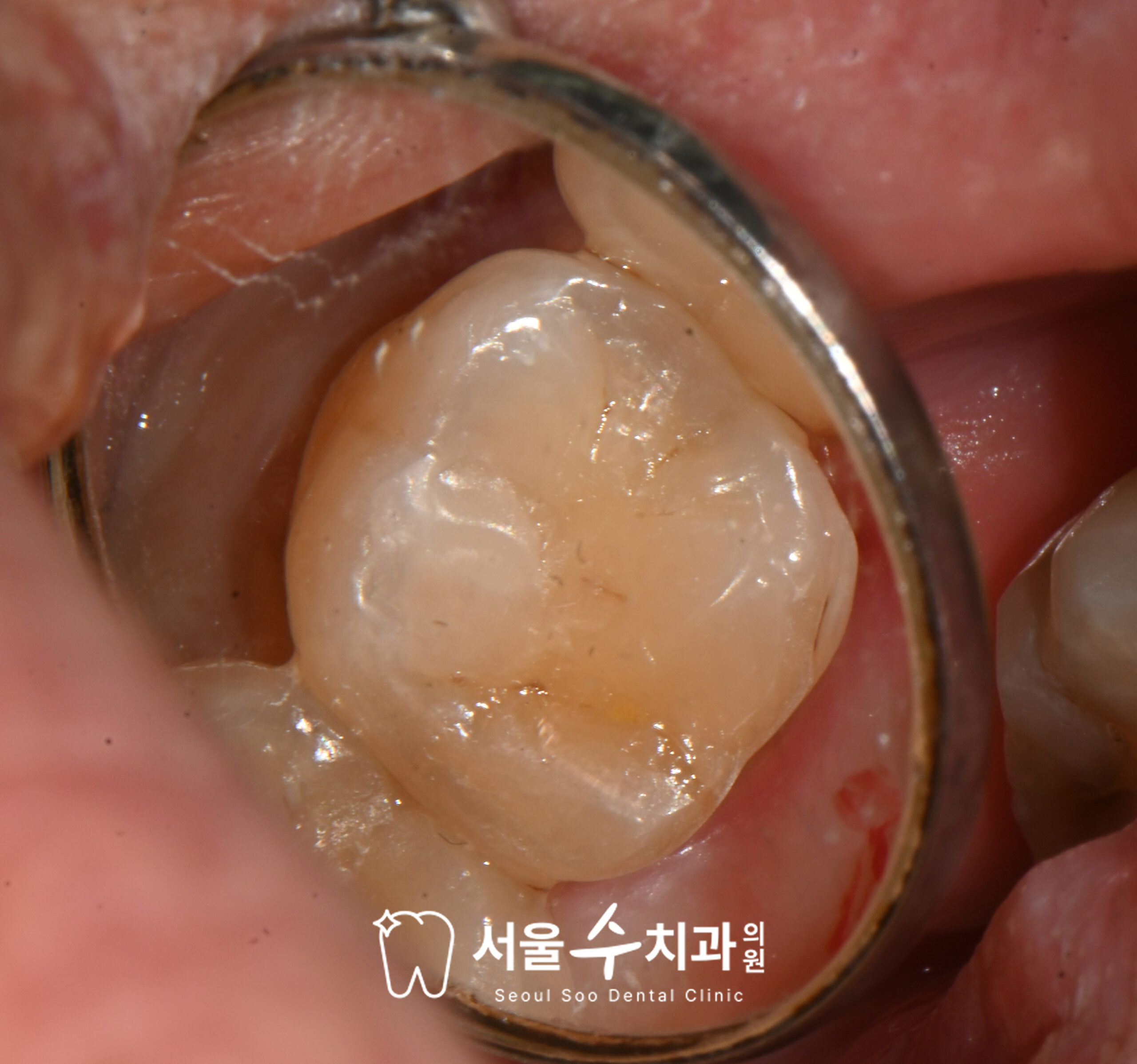 영구치 복합레진 충전 치료 — 청원구치과 서울수치과