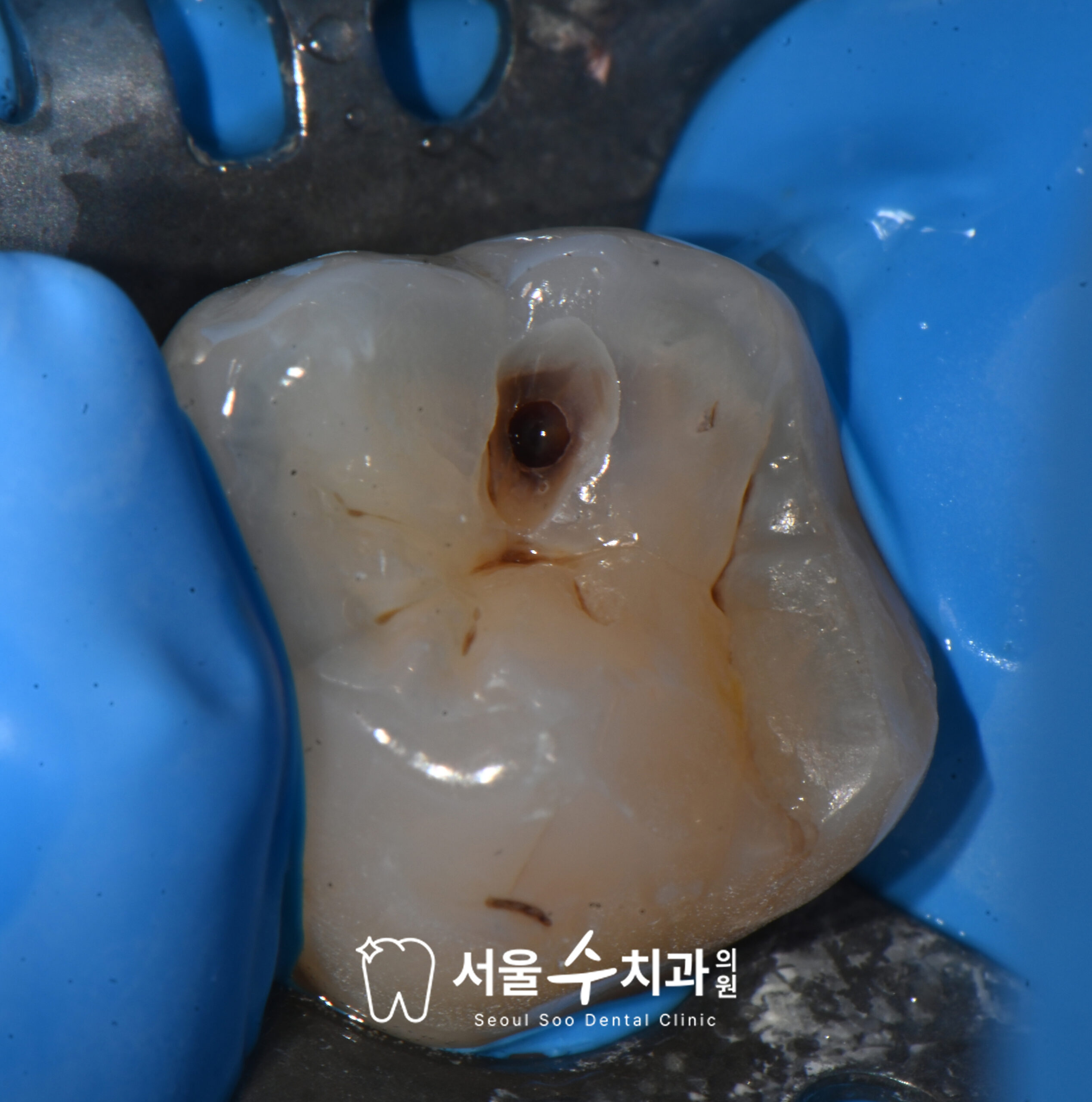 영구치 충치 제거 과정 — 청원구치과 서울수치과